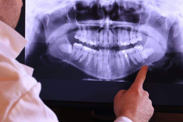 Best Emergency Wisdom Teeth Removal in La Fayette, AL