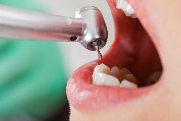 Best Emergency Tooth Extraction in La Fayette, AL